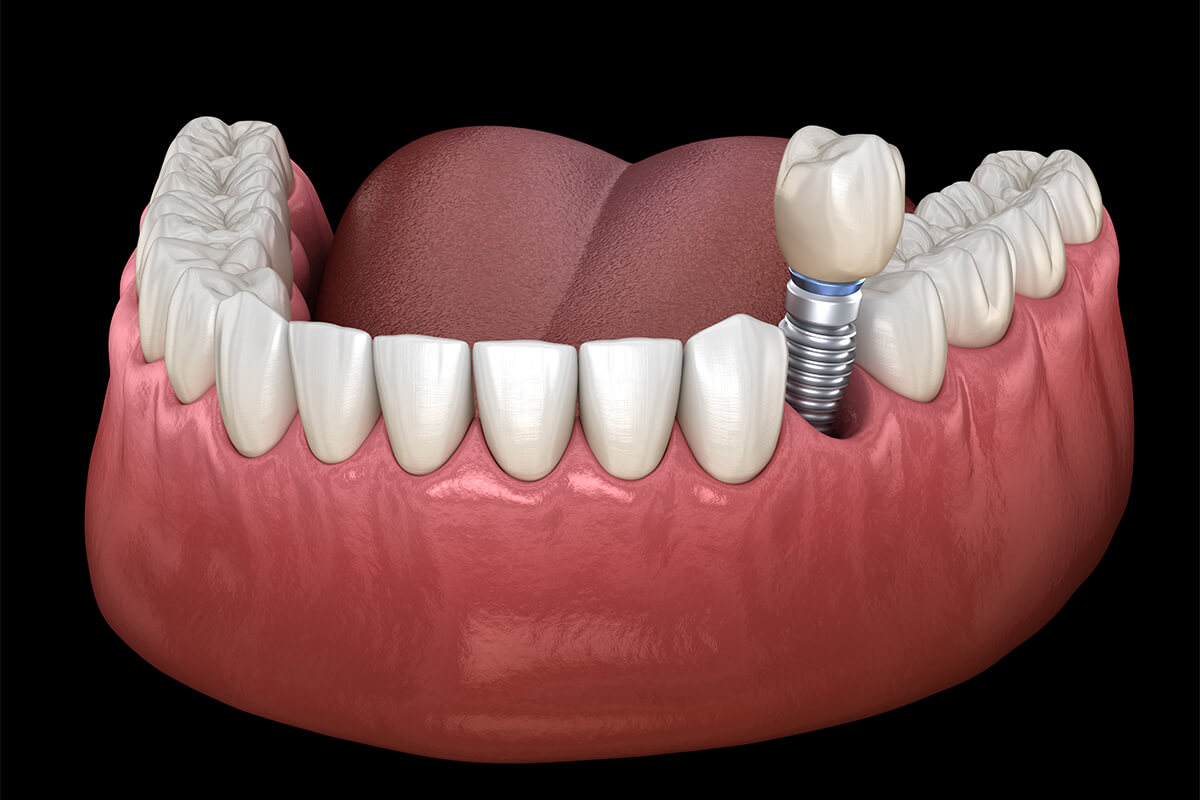 Teeth Implants Process in Mesa AZ Area