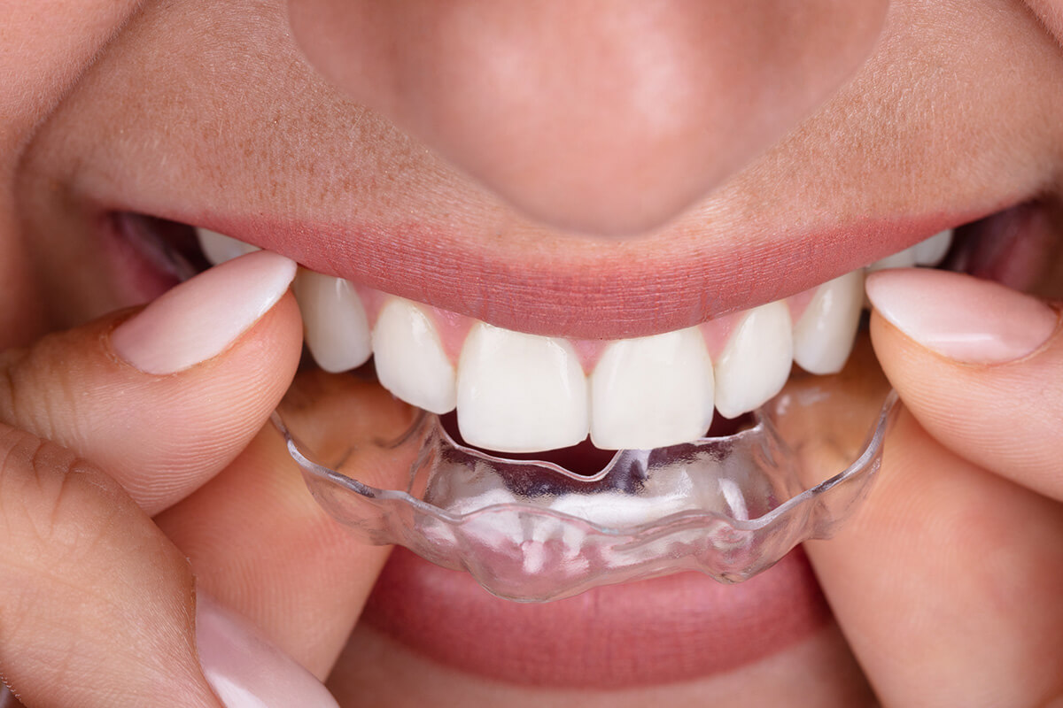 Find an Invisalign Doctor in Mesa AZ Area