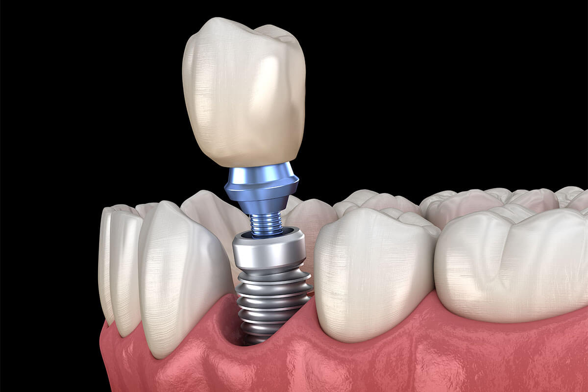 Dental Implant Cost Near Me Mesa AZ Area